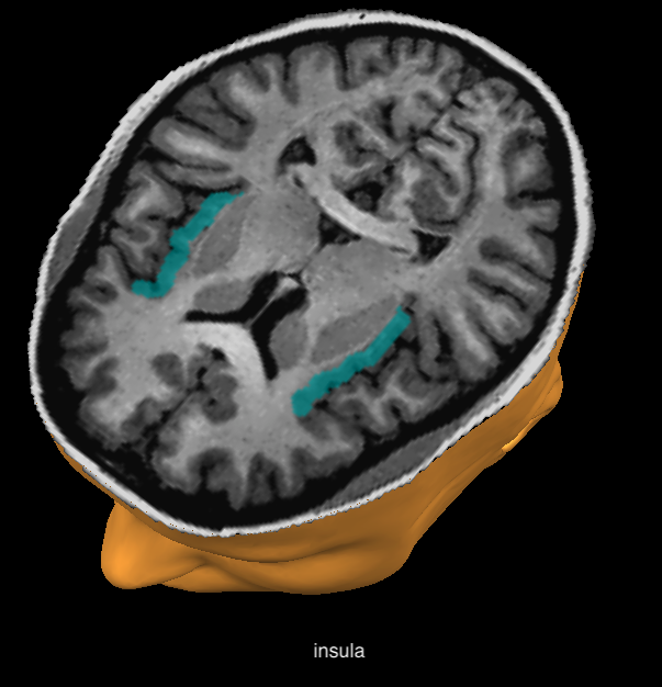 Imagine RMN cu regiunea insulei din creier